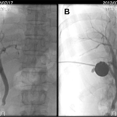 Contrast Enhanced Ct Scan A B Marked Gallbladder Distention G 55