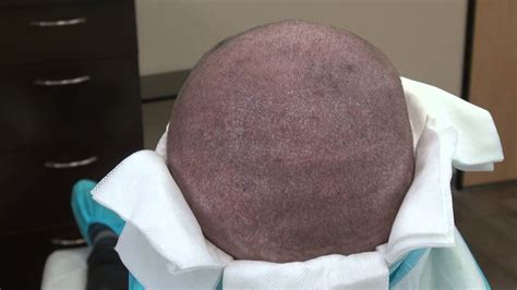 Fue Hair Transplant Surgery 1 Year Post Operation Donor Scar Dr Diep