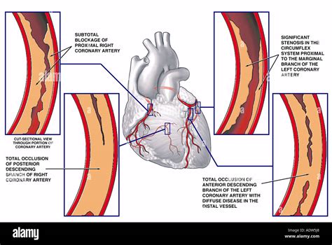 Coronary Artery Disease With Blockage Sites Stock Photo Alamy