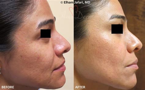 Fraxel Laser Before And After Pores Change Comin