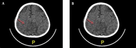 Head Computed Tomography Ct Scan With Contrast A Cerebral