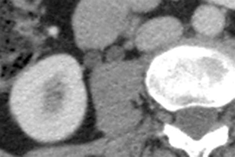 Double Ureter Right As Seen On An Axial Ct Normal Variant In 2020