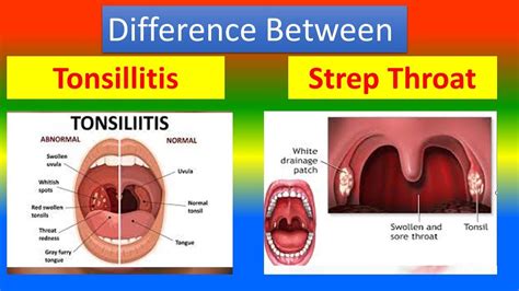 Difference Between Tonsillitis And Strep Throat Youtube
