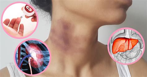 unexplained bruising on your body what s causing them
