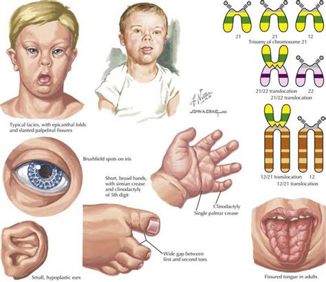Down S Syndrome Overview Symptoms And Diagnosis Blog HubBlog Hub