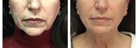 Kybella Double Chin Treatment And Removal Mirabile Md Beauty Clinic