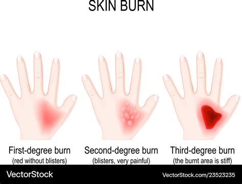 Degree Burns Of Skin Step Of Burn Royalty Free Vector Image