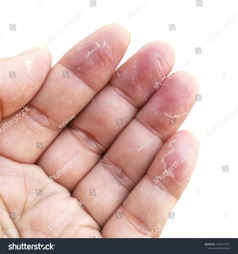 Fingers Dry Skin Problem Dermatitis Eczema Stock Photo 1602917911