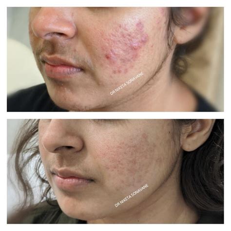 Acne Scars Treatment In Mumbai Best Dermatologist In Mumbai