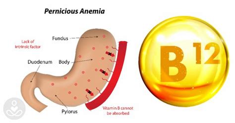 Deficiencia De Vitamina B12 Causas Síntomas Prevención Y Tratamiento