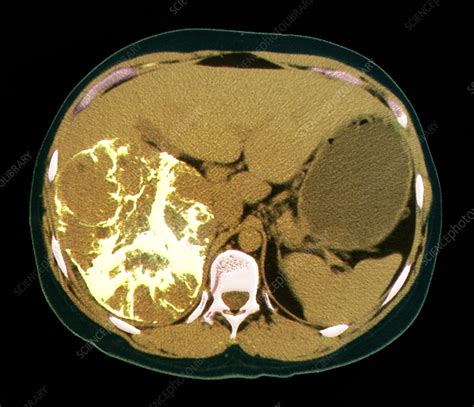 Liver Cancer Ct Scan Stock Image C0104903 Science Photo Library