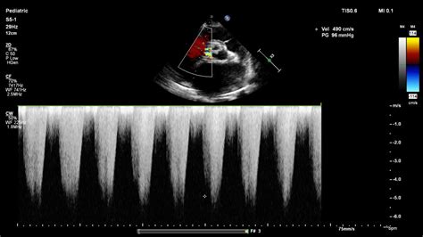 Severe Pulmonary Hypertension Estimated By Tr Jet Sujyotheartclinic