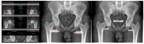 Differences Of Anteroposterior Pelvic Radiographs Between 55 Off