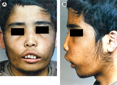 Superior Repositioning Of The Maxilla In Thalassemia Induced Facial Deformity Report Of 3 Cases