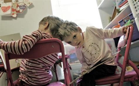 Doctor Rules Out Surgery For Conjoined Twins The Boston Globe
