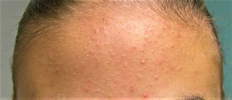 Whiteheads Causes Find Out How To Get Rid Of Whiteheads