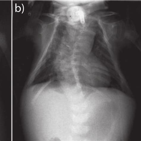 Chest X Rays Of The Infant Showing 11 Pairs Of Ribs Posterior Rib Gap