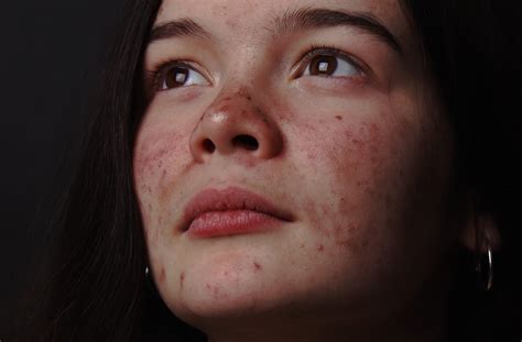 Acne And Eczema How To Look After Your Skin Talented Ladies Club