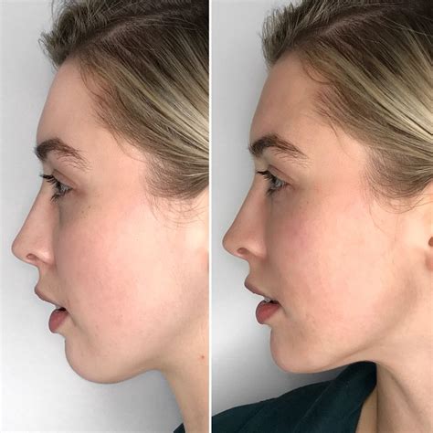 Jawline Contouring Example 4 Concept Clinics Aesthetics And Cosmetic
