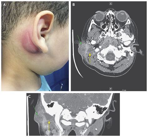 First Branchial Cleft Cyst Nejm
