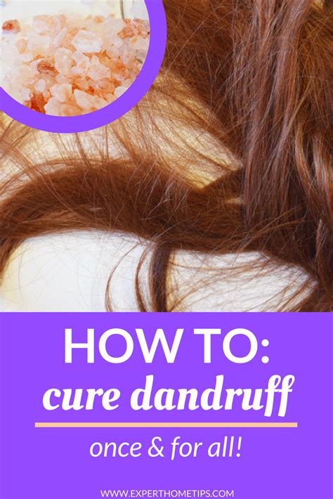 Dandruff Dilemma Find A Dandruff Cure That Works Today Expert Home Tips