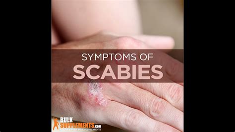 What Is Scabies Symptoms Of Scabies YouTube