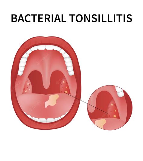 723 Images Of Viral Tonsillitis Pics Myweb