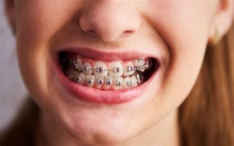 Choosing The Right Type Of Dental Braces For You Dentist Sarnia
