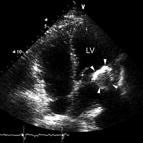 Liquefaction Necrosis Of Mitral Annulus Calcification Circulation