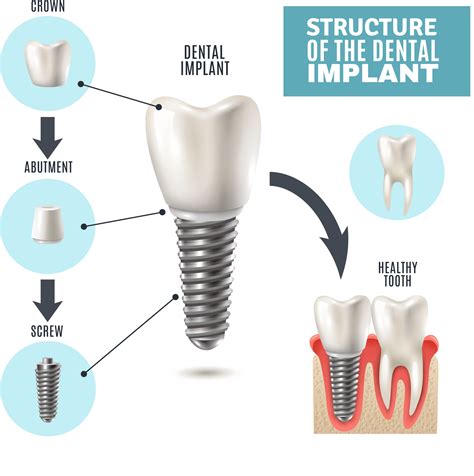 What Is A Dental Implant Ddi Dorset