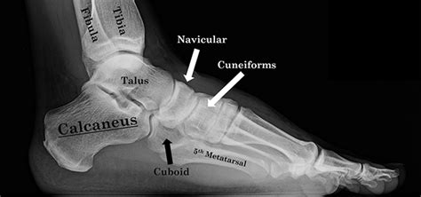 Calcaneus Fracture Broken Heel Bone Orthopaedic Trauma Association