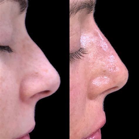 Before And After Photos Nose Reshaping Nyc