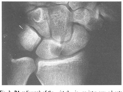 Figure From Intraosseous Ganglion Cyst Of The Lunate Diagnosis And Management Semantic Scholar