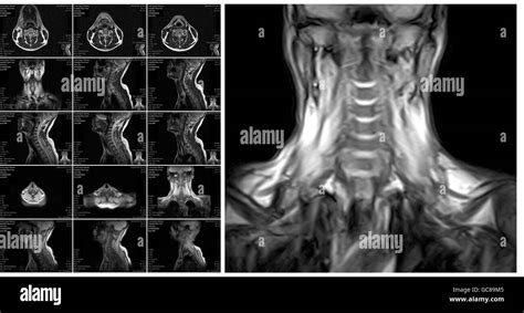 Magnetic Resonance Imaging Of The Cervical Spine Stock Photo 110821317