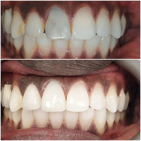 The Best Teeth Whitening Procedure Regent Dental Cambridge
