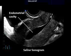 This article covers the most common process of ivf. Saline Sonogram (With images) | Saline sonogram