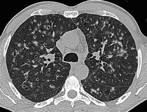 Pulmonary Langerhans Cell Histiocytosis Lung Ct Scan Stock Image