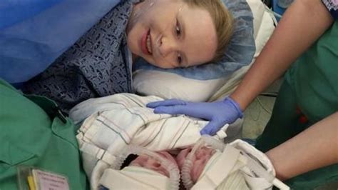 Rare Conjoined Twins Sharing A Heart Born In Georgia With Images