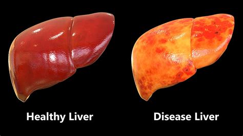 Fatty Liver Disease Nursing And Health Care Health Care Researches
