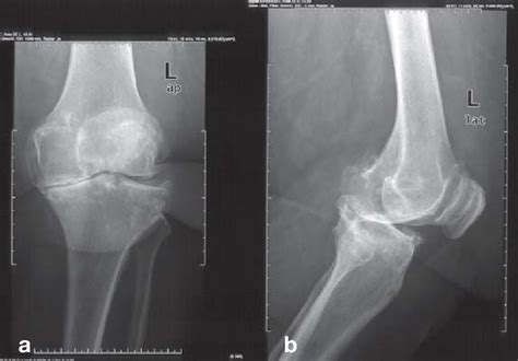 Plain X Rays Of The Left Knee In Kellgren And Lawrence Stage 4 A Ap