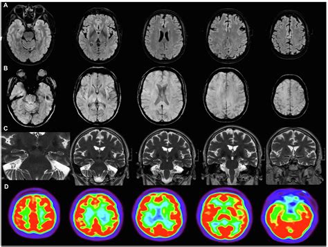 Frontiers “brain Fog” By Covid 19 Or Alzheimers Disease A Case Report