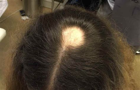 Alopecia Areata Causes Symptoms And Treatment