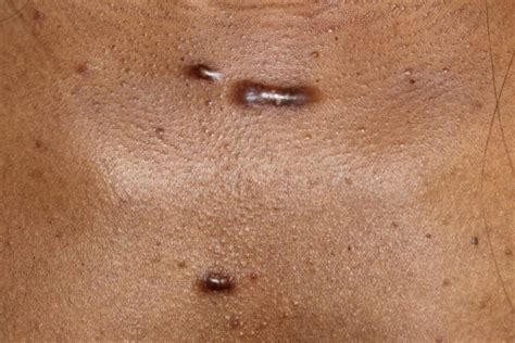 What Exactly Are Keloids And Effective Ways To Treat Them Guide