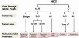 Images of Hcc Hepatocellular Carcinoma Treatment