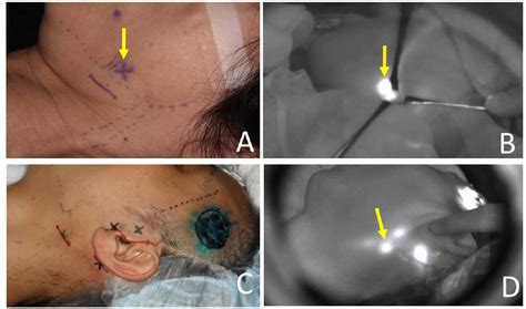 Figure 4 From Sentinel Lymph Node Biopsy For Melanoma And Surgical