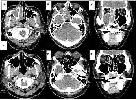 Computed Tomography Ct Of The Sinonasal Region Axial View A B D E