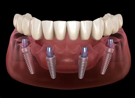 ¿cuántos Tipos De Implantes Dentales Hay Clínica Deltadent