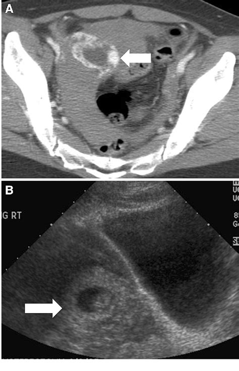 Radiological Appearances Of Corpus Luteum Cysts And Their Imaging