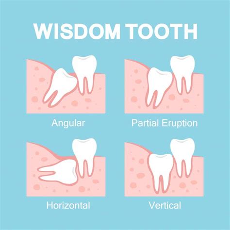 Wisdom Teeth Removal Cost Breakdown Teeth Wisdom