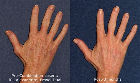 Hand Skin Rejuvenation Med Spa San Diego Ca Clderm